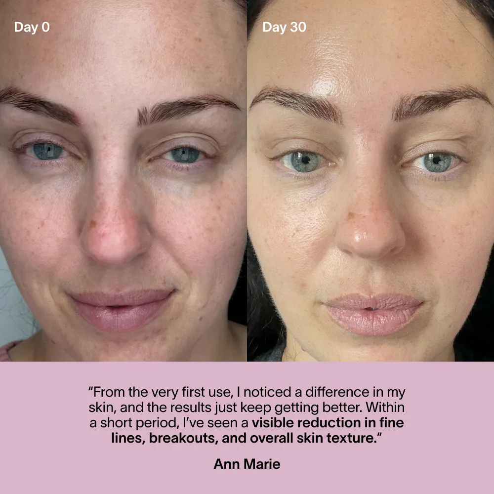 Before and after skincare comparison with testimonial text below.