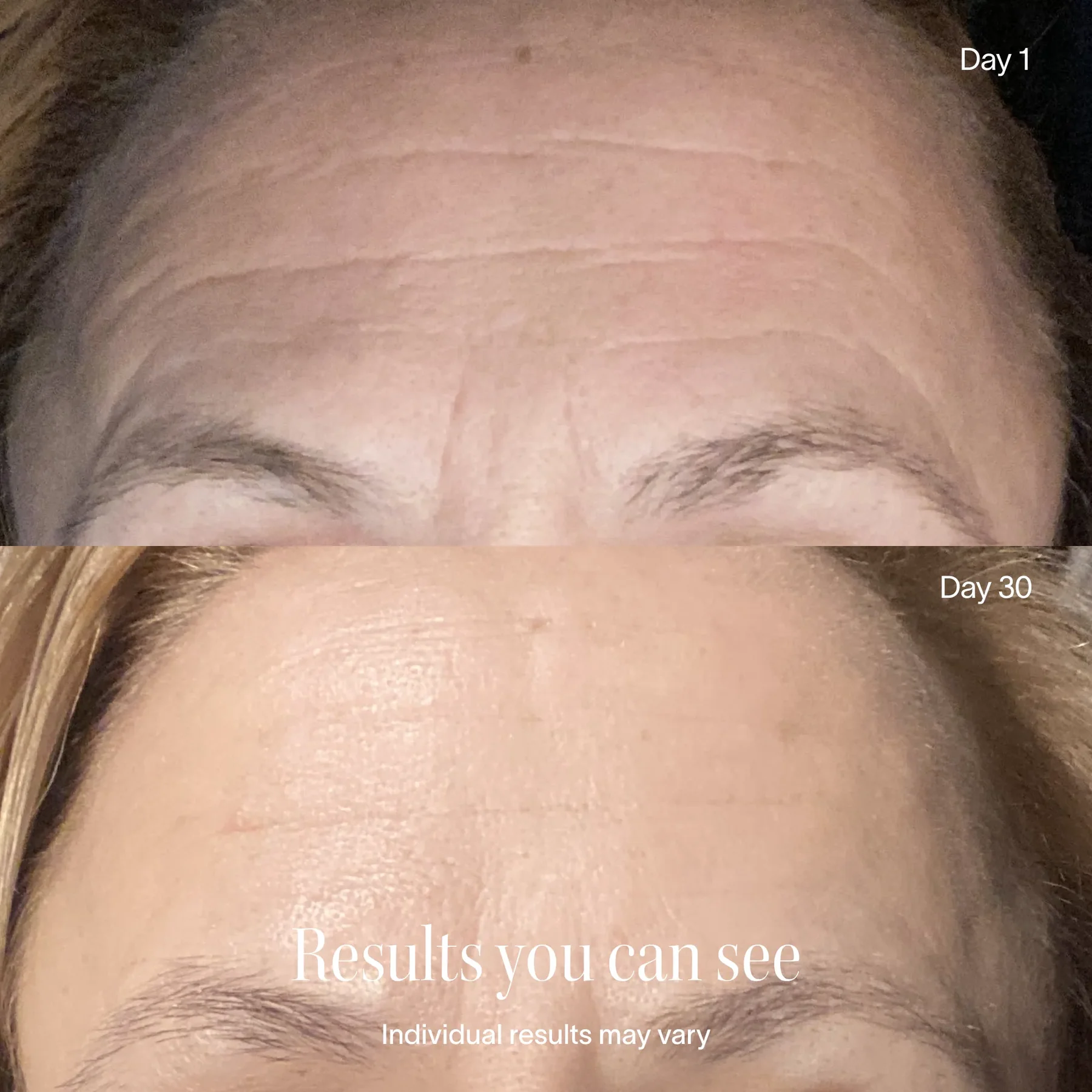 Comparison of a forehead on Day 1 and Day 30, showing reduced wrinkles.