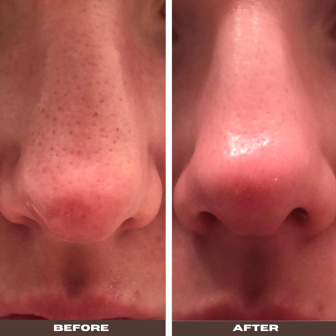 Side-by-side nose close-up before and after skin treatment.