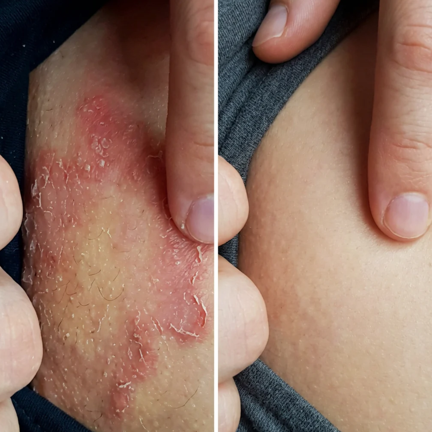 A before and after split image showing inflamed, flaky skin on the left and clear skin on the right.