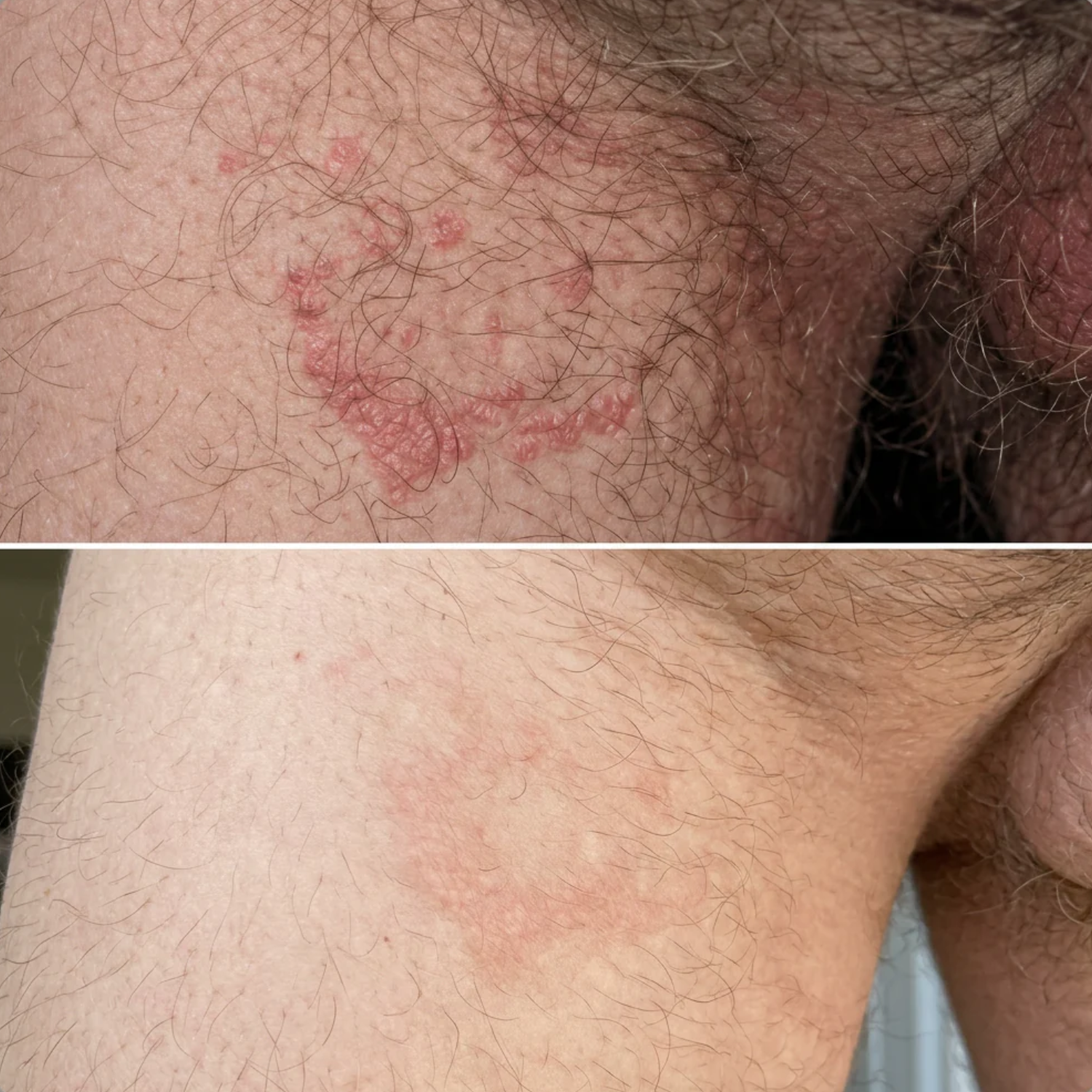 A before-and-after comparison of a red, blistering skin rash on hairy skin, showing its healed state below.