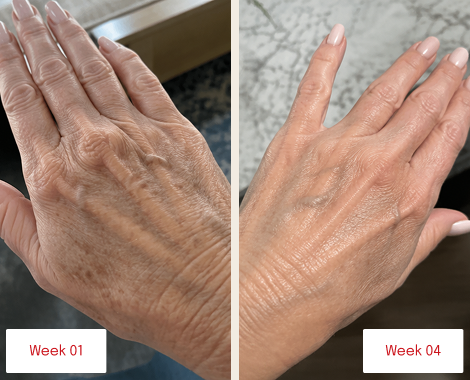 A before and after image showing a hand's skin at week one and week four with fewer wrinkles.