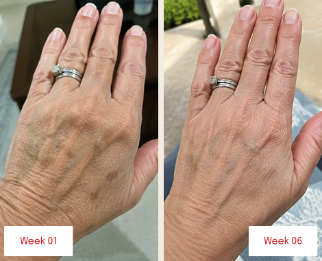 Before and after photos of a hand, showing reduced dark spots and wrinkles between week 1 and week 6.
