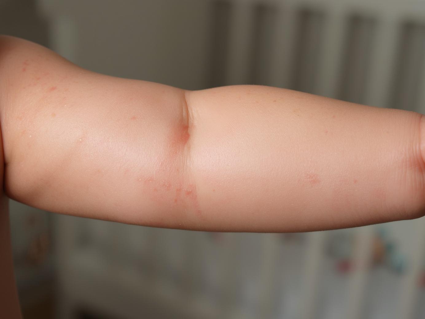 Close-up of a baby's arm with mild red rash.